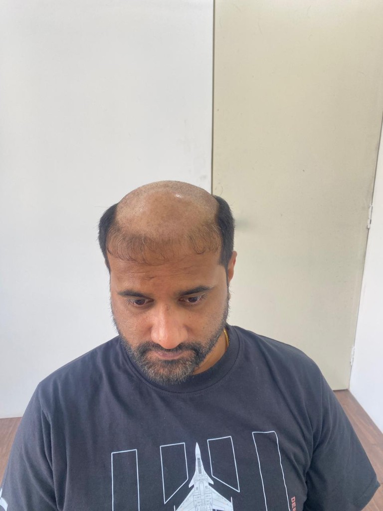 Before hair patch treatment